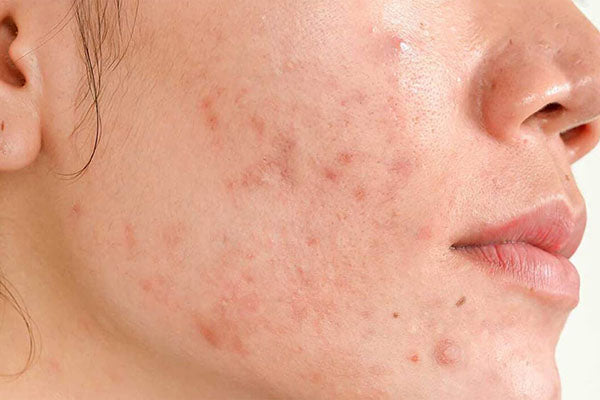 How To Get Rid Of Hormonal Acne